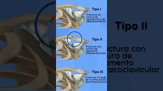 Fracturas de clavícula 🩻 [upl. by Amliw]