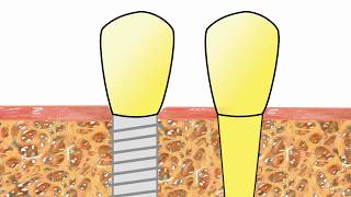 Die Entzündung am Implantat Ursache und Behandlung [upl. by Aruol]