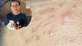 Acne Treatment Huong Da Nang  2024 blackheads 700 [upl. by Anirt]