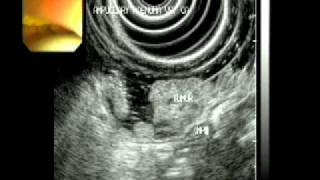 Ampullary adenoma on endoscopic ultrasound [upl. by Bail]