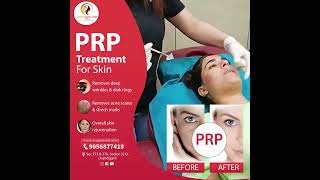 PRP Treatment For Skin [upl. by Onder]