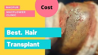 hair transplant cost in Nagpur and review [upl. by Annaierb965]