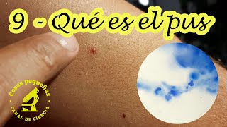 9 Qué contiene el pus [upl. by Ennaylloh]