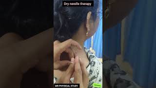 Dry Needles therapy doctor physio shoulderinjury orthodox aiims trending treatment pain [upl. by Delogu]