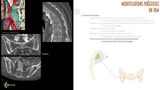 TUTORIEL IMOSTEO 14 IRM des sacroiliaques Modifications pièges [upl. by Petrine]