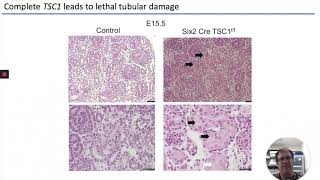 TSCassociated cystic kidney disease is prevented in pregnancy [upl. by Huberto]