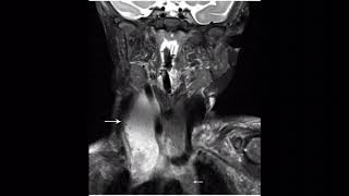 Thymic cyst [upl. by Aliek]