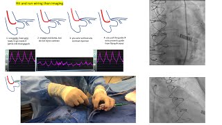 Aortoostial angiography and stenting tips and tricks  case illustrations Elias Hanna [upl. by Bolte832]