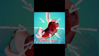 Stomach Endoscopy animation trendingshortstrendingshortsshortfeed [upl. by Lepine]