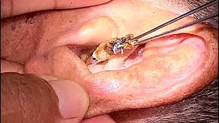 remove earwaxbut the mixture of wax is eyecatching耳垢を取り除くearwaxremoval earwaxcleaner [upl. by Macdermot]