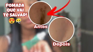 POMADA PARA ESPINHAS ACNE QUE SALVA EM POUCOS DIAS 😍 [upl. by Kcid404]