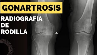 Radiografía de rodilla ap [upl. by Adnilev]