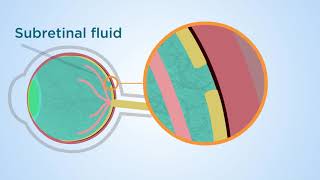 Subretinal fluid a novel approach to macular holes [upl. by Neelyaj]