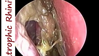 Atrophic Rhinitis Ozaena  Operated Youngs on Left amp Modified Youngs operation on Right [upl. by Nnaear825]