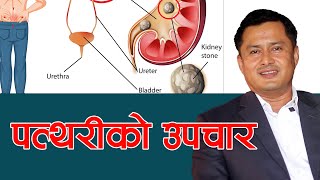 मिर्गौला र मुत्र नलिको पत्थरी भए कसरी उपचार गर्ने Prof Dr Sudip Raj KC  NIKO NEPAL [upl. by Paske]