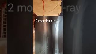 my femur bone fracture and recovery xrays [upl. by Olegnaid]