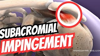 Subacromial Impingement Syndrome Presentation  Orthopaedics High Yield Topics 13 [upl. by Anikas32]