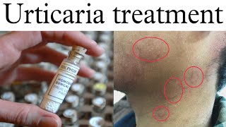 Urticaria Homeopathy Treatment  Pitti Uchalne Par Kiya Karte Hain  Urticaria Treatment In Hindi [upl. by Amada]