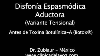 Disfonía Espasmódica Variante Tensional pre y post Botox® [upl. by Kienan]