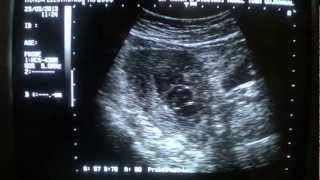 INCOMPLETE ABORTION ultrasound [upl. by Reh910]