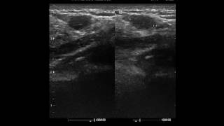 CASE 281 SONOMAMMOGRAPHY FIBROADENOSIS [upl. by Drucilla46]