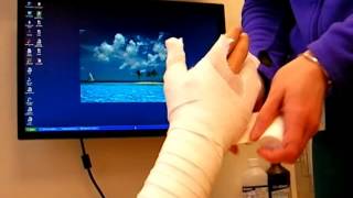 How to Make a Cast for a Hand Fracture  Nicky Leung MD [upl. by Divadnahtanoj]