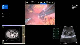 BK Medical Robotic Assisted Partial Nephrectomy RAPN by Dr James R Porter [upl. by Renee545]