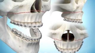 Maxillary Advancement Surgery [upl. by Rosenberg771]