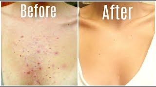 How I Got Rid Of My Body Acne FOREVER [upl. by Ferdy]