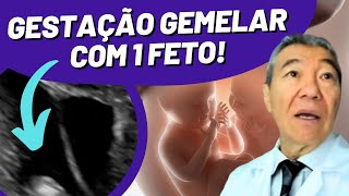 LIVE GESTAÇÃO GEMELAR COM 1 FETO [upl. by Einnek]