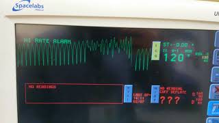 EKG Simulated Cardiac Arrest  NSR to Vtach to Vfib to Asystole [upl. by Camel]