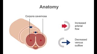 Diagnosing priapism [upl. by Cardon]