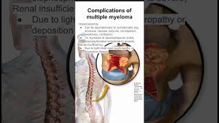 Complications of multiple myeloma [upl. by Bridgette]