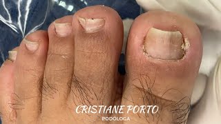 😳 UNHA ATROFIADA JÁ VIRAM nails ingrowntoenail [upl. by Ainedrag]