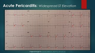 Acute Pericarditis ECG [upl. by Aynom]