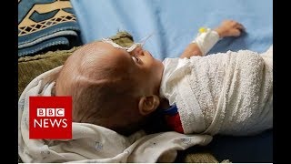 How children are starving in Yemens war  BBC News [upl. by Esiom488]