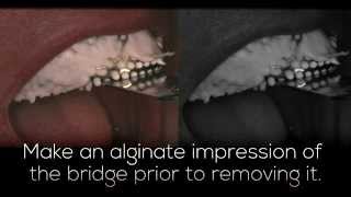 Temporary Dental Bridge [upl. by Helenka]