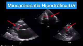 Miocardiopatía Hipertrófica Fácil 1 mecanismo [upl. by Laved]