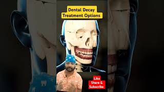 Dental Cavity treatment Optionsyt ytshorts shorts dental ytshortsindia teethdentalcavity [upl. by Ceciley986]