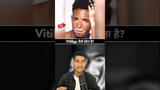 The Truth About Vitiligo explained [upl. by Nanyk]