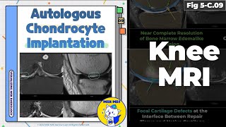 Fig 5C09 MRI Findings of Autologous Chondrocyte Implantation [upl. by Sergent]