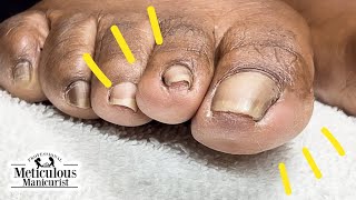 How to Fix Toenail Discomfort [upl. by Lorrimor]