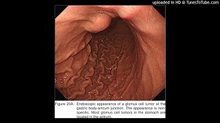 Gastric Neuroendocrine Tumor in a Deep Layer of Submucosa With Diagnosis by Endoscopic UltrasoundGu [upl. by Vickie]