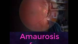 Amaurosis Fugax [upl. by Yentyrb242]