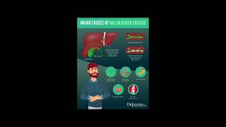 cholelithiasis nutritional factors [upl. by Mossolb845]