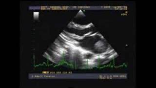 Mobile clot inside left atrium [upl. by Itnava]