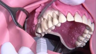 Periodontal surgery Modified Widmann flap [upl. by Ximena817]