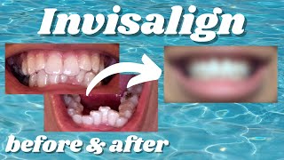 My Incredible Invisalign Transformation [upl. by Eniamaj]