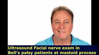 Ultrasound Facial nerve examination on Bells palsy patients at mastoid process level [upl. by Duma]