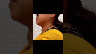 Large thyroid goitre treatment by Radiofrequency ablation RFA [upl. by Lilithe524]